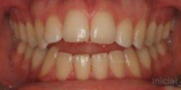 antes de ortodoncia con Clinica Tello